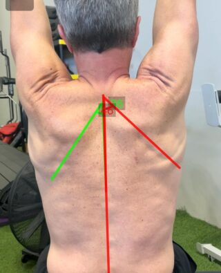 Shoulder pain with overhead reaching? ⁠
⁠
*The shoulder complex can be complicated---there are a lot of moving parts! But I am going to be slightly biased here and say the most important part is the scapula. What is your shoulder blade doing that could be contributing to your shoulder pain?!?⁠
⁠
*Fair Warning---everyone with shoulder pain that comes to see me will take their shirt off. You just can't evaluate the shoulder properly without seeing what the scapula is doing! This is a measurement tool that I like to use to put a number to the scapula movement. Sure, there's room for error, but it gives a good visualization to the patient so they can understand what's going on.⁠
⁠
